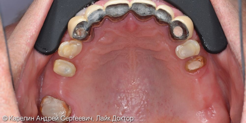 Поднятие высоты нижнего отдела лица, восстановление функции жевания и эстетики с помощью металлокерамических коронок на зубы и имплантаты, цельнолитых коронок - фото №5