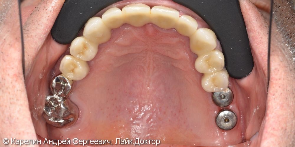 Поднятие высоты нижнего отдела лица, восстановление функции жевания и эстетики с помощью металлокерамических коронок на зубы и имплантаты, цельнолитых коронок - фото №11