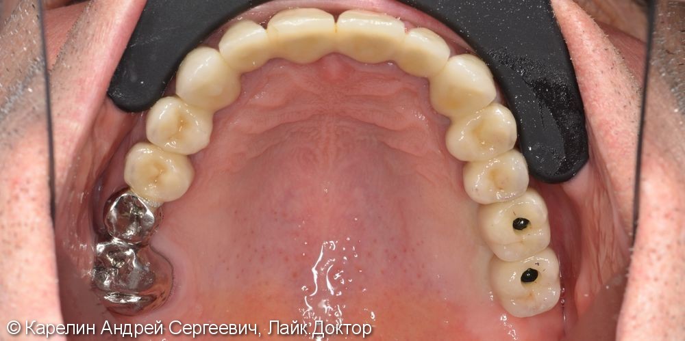 Поднятие высоты нижнего отдела лица, восстановление функции жевания и эстетики с помощью металлокерамических коронок на зубы и имплантаты, цельнолитых коронок - фото №12