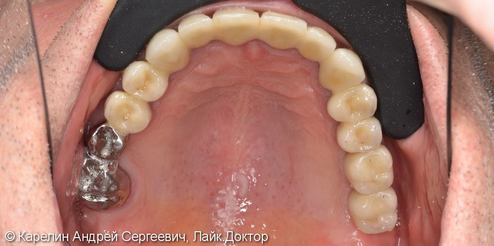 Поднятие высоты нижнего отдела лица, восстановление функции жевания и эстетики с помощью металлокерамических коронок на зубы и имплантаты, цельнолитых коронок - фото №13