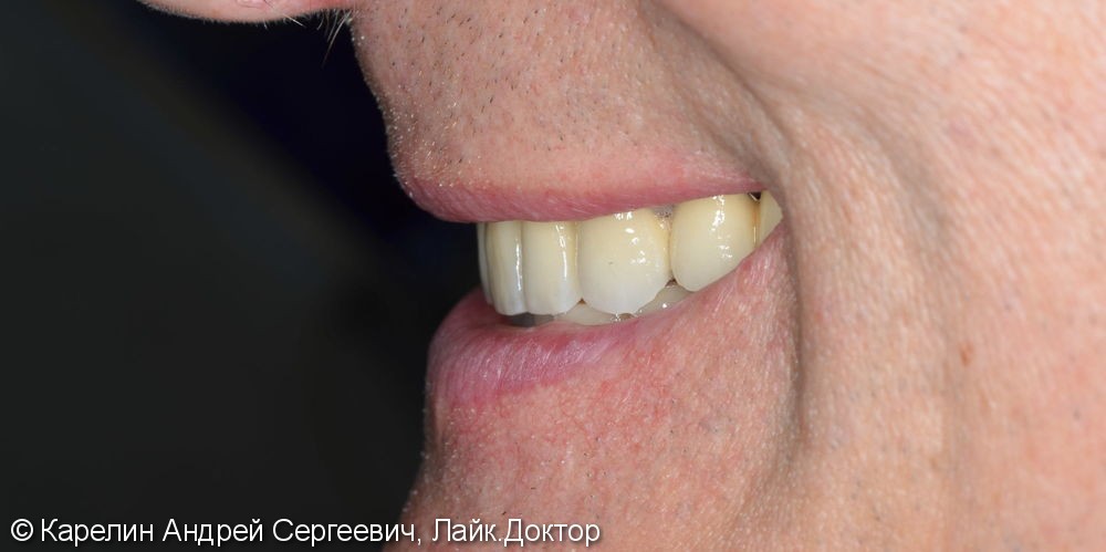Поднятие высоты нижнего отдела лица, восстановление функции жевания и эстетики с помощью металлокерамических коронок на зубы и имплантаты, цельнолитых коронок - фото №17