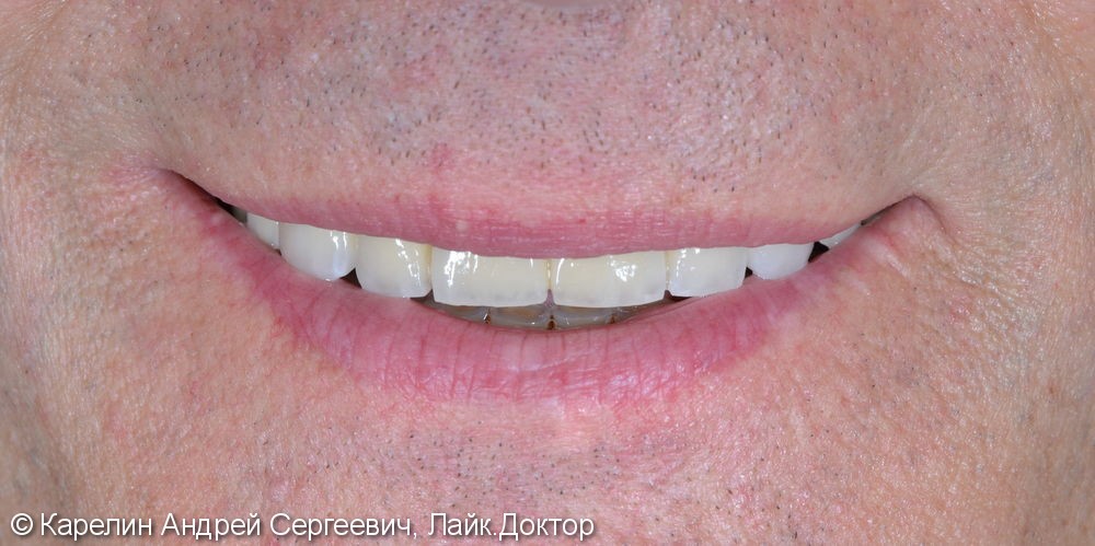 Поднятие высоты нижнего отдела лица, восстановление функции жевания и эстетики с помощью металлокерамических коронок на зубы и имплантаты, цельнолитых коронок - фото №18