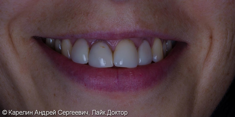 4 коронки, 2 винира E.max на передних зубах, до и после - фото №1