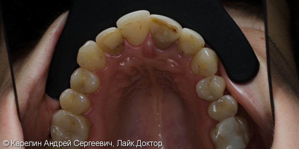 4 коронки, 2 винира E.max на передних зубах, до и после - фото №9