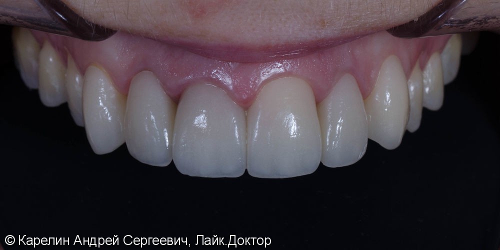 4 коронки, 2 винира E.max на передних зубах, до и после - фото №11
