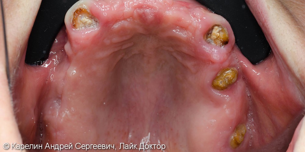 Лечение полной адентии с помощью съёмных протезов с балочной фиксацией на имплантаты - фото №2