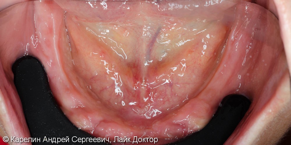 Лечение полной адентии с помощью съёмных протезов с балочной фиксацией на имплантаты - фото №3