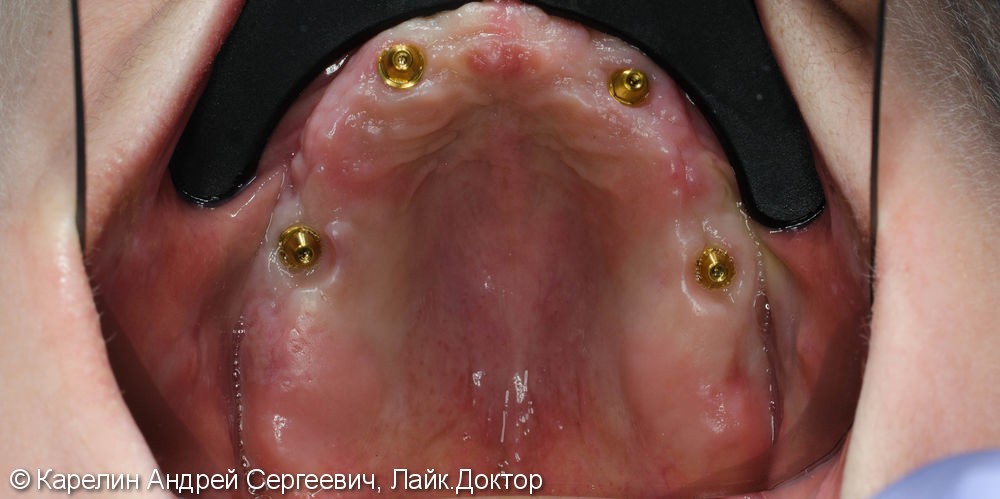 Лечение полной адентии с помощью съёмных протезов с балочной фиксацией на имплантаты - фото №4