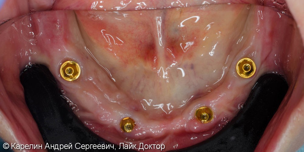 Лечение полной адентии с помощью съёмных протезов с балочной фиксацией на имплантаты - фото №5
