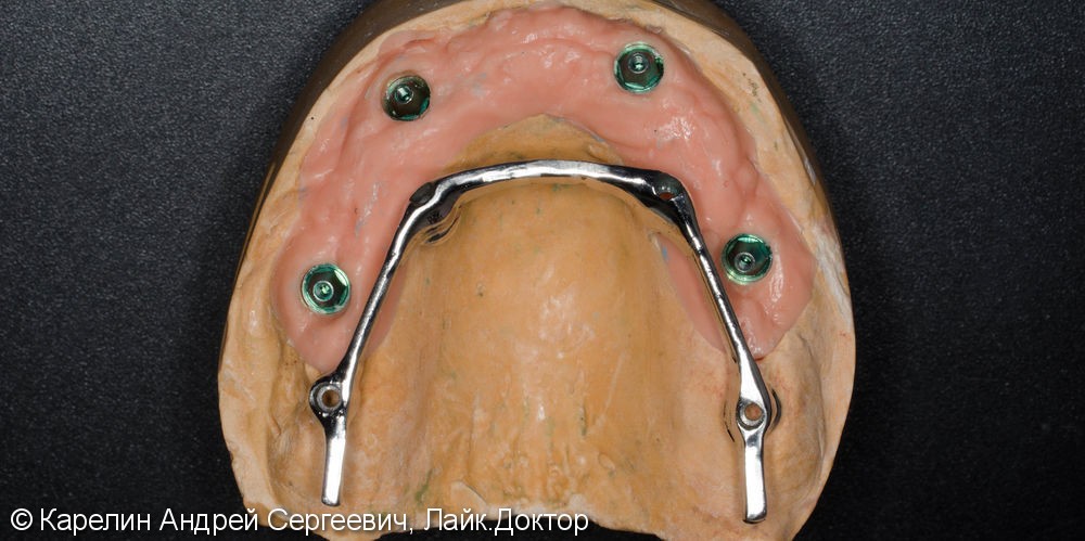 Лечение полной адентии с помощью съёмных протезов с балочной фиксацией на имплантаты - фото №6