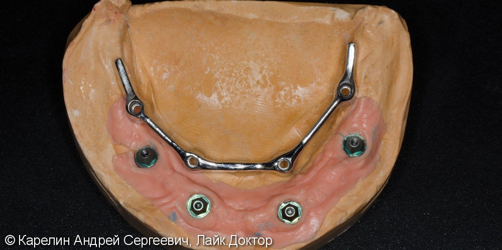 Лечение полной адентии с помощью съёмных протезов с балочной фиксацией на имплантаты - фото №7