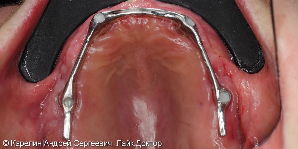 Лечение полной адентии с помощью съёмных протезов с балочной фиксацией на имплантаты - фото №8