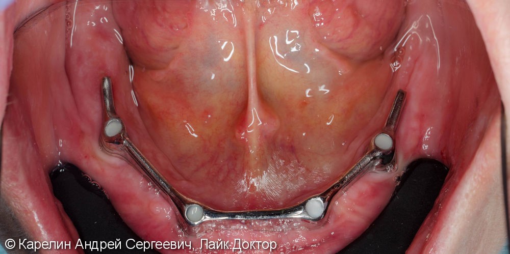 Лечение полной адентии с помощью съёмных протезов с балочной фиксацией на имплантаты - фото №9