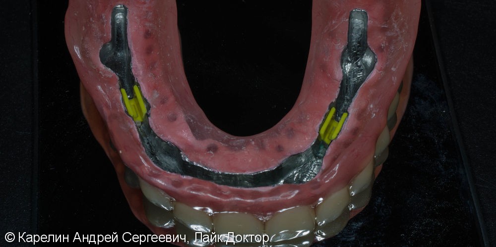 Лечение полной адентии с помощью съёмных протезов с балочной фиксацией на имплантаты - фото №11