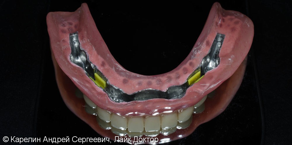 Лечение полной адентии с помощью съёмных протезов с балочной фиксацией на имплантаты - фото №13