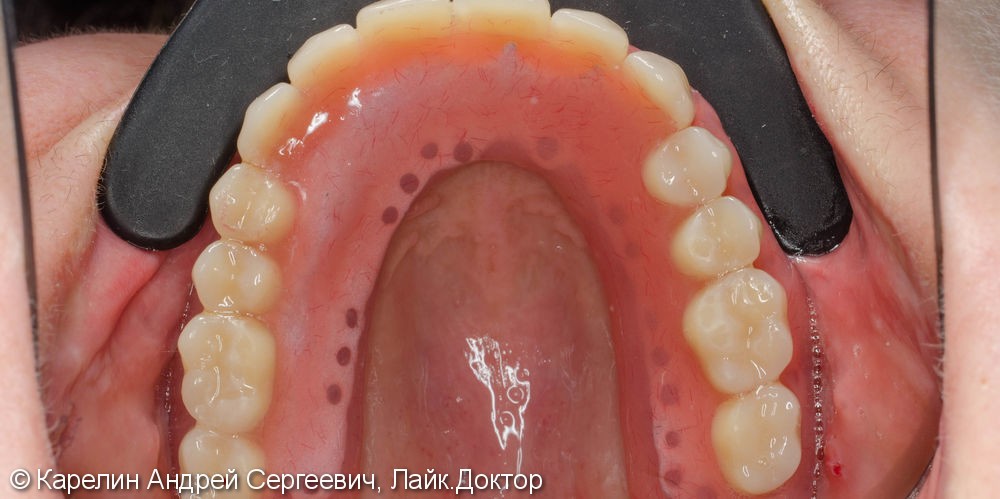 Лечение полной адентии с помощью съёмных протезов с балочной фиксацией на имплантаты - фото №15