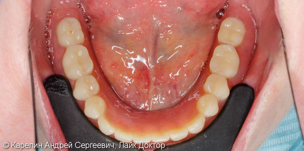 Лечение полной адентии с помощью съёмных протезов с балочной фиксацией на имплантаты - фото №16