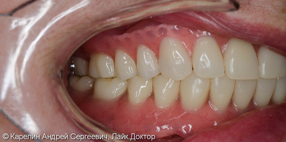 Лечение полной адентии с помощью съёмных протезов с балочной фиксацией на имплантаты - фото №17