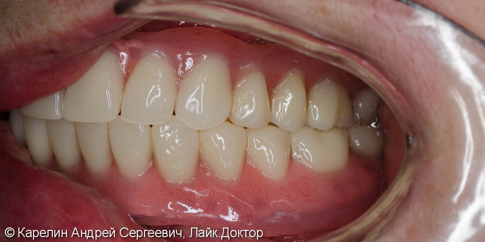 Лечение полной адентии с помощью съёмных протезов с балочной фиксацией на имплантаты - фото №18