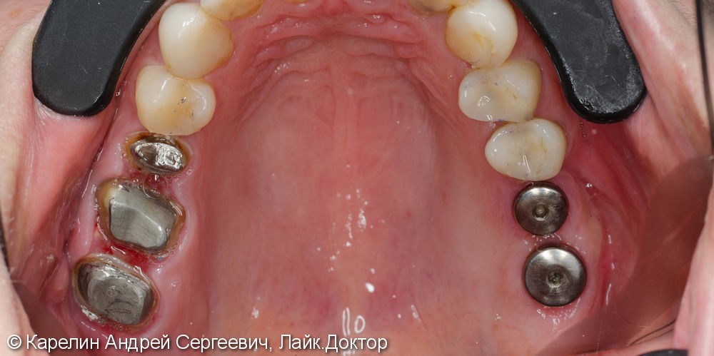 Протезирование жевательной группы обеих челюстей металлокерамическими коронками на имплантатах и зубах - фото №1