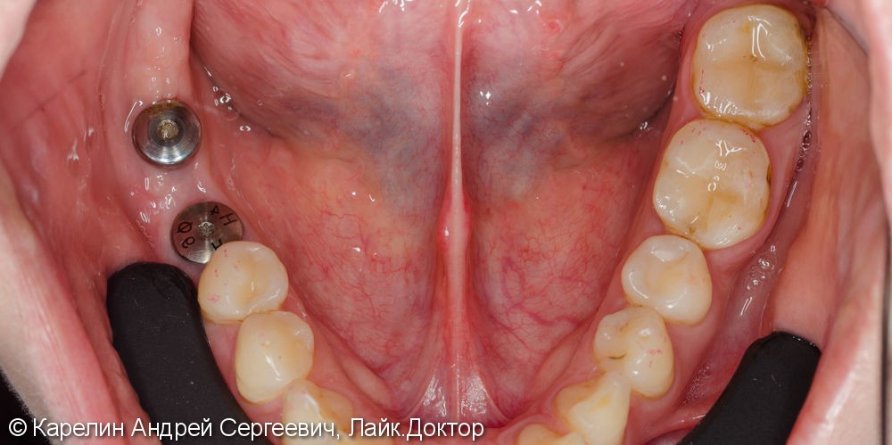 Протезирование жевательной группы обеих челюстей металлокерамическими коронками на имплантатах и зубах - фото №2