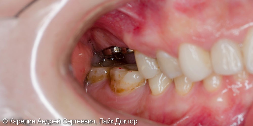 Протезирование жевательной группы обеих челюстей металлокерамическими коронками на имплантатах и зубах - фото №3