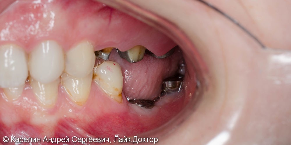 Протезирование жевательной группы обеих челюстей металлокерамическими коронками на имплантатах и зубах - фото №4