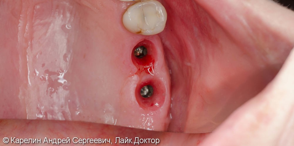 Протезирование жевательной группы обеих челюстей металлокерамическими коронками на имплантатах и зубах - фото №5