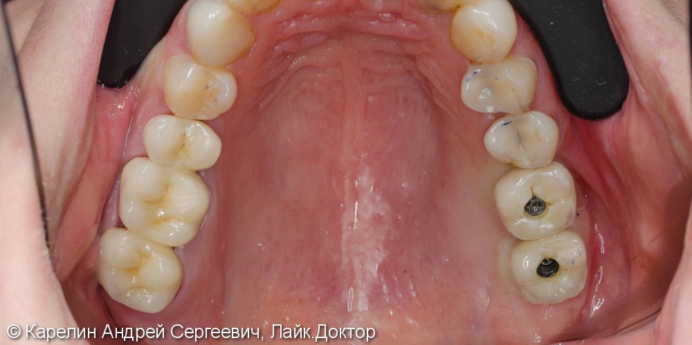 Протезирование жевательной группы обеих челюстей металлокерамическими коронками на имплантатах и зубах - фото №6