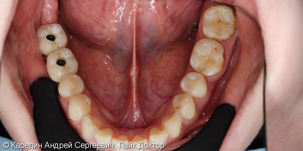 Протезирование жевательной группы обеих челюстей металлокерамическими коронками на имплантатах и зубах - фото №7