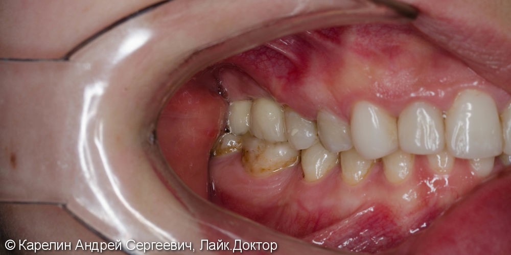 Протезирование жевательной группы обеих челюстей металлокерамическими коронками на имплантатах и зубах - фото №8