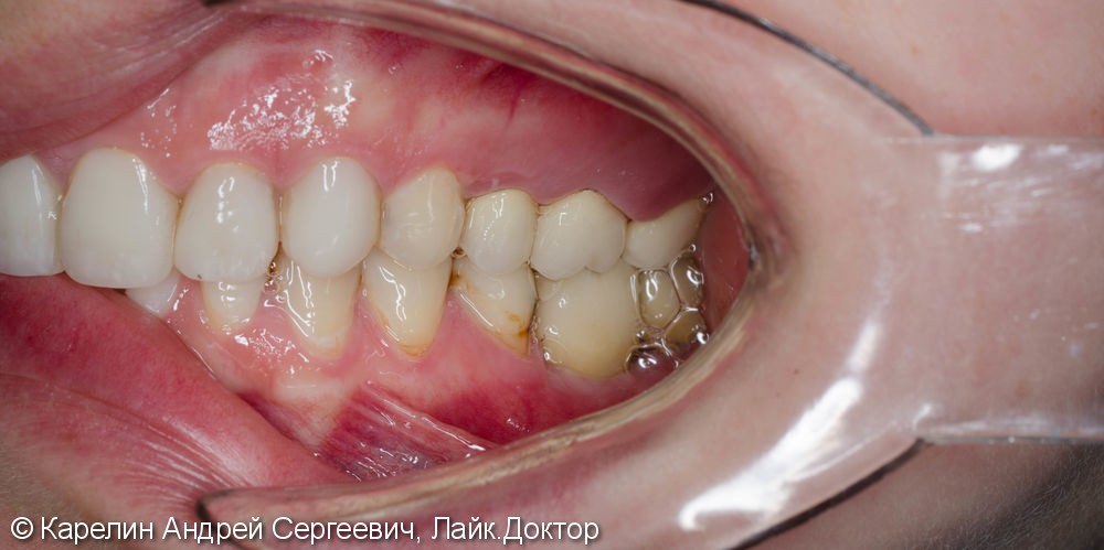Протезирование жевательной группы обеих челюстей металлокерамическими коронками на имплантатах и зубах - фото №9
