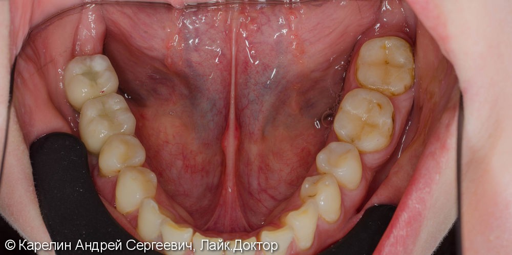 Протезирование жевательной группы обеих челюстей металлокерамическими коронками на имплантатах и зубах - фото №10