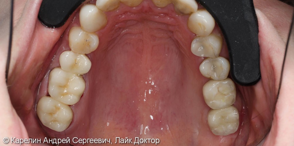 Протезирование жевательной группы обеих челюстей металлокерамическими коронками на имплантатах и зубах - фото №11