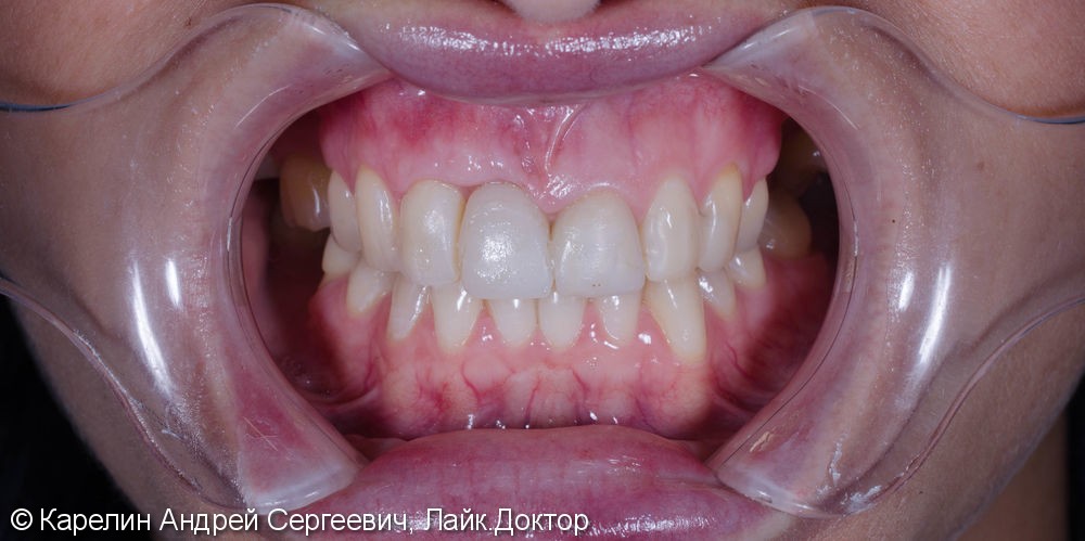 Эстетическая реабилитация фронталной группы зубов с помощью имплантата, коронок и виниров E.max - фото №2