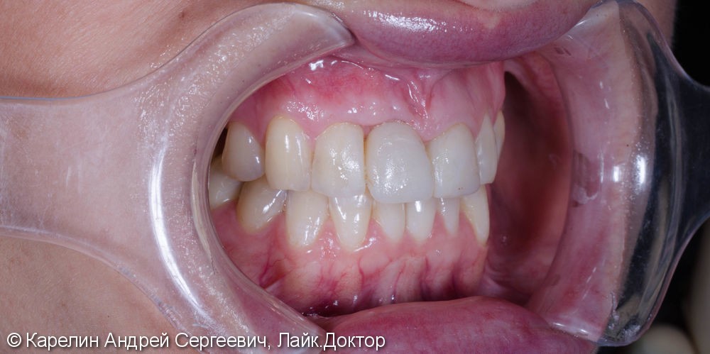 Эстетическая реабилитация фронталной группы зубов с помощью имплантата, коронок и виниров E.max - фото №3