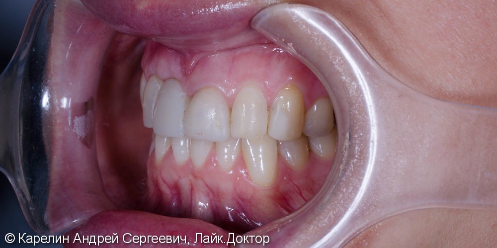 Эстетическая реабилитация фронталной группы зубов с помощью имплантата, коронок и виниров E.max - фото №4