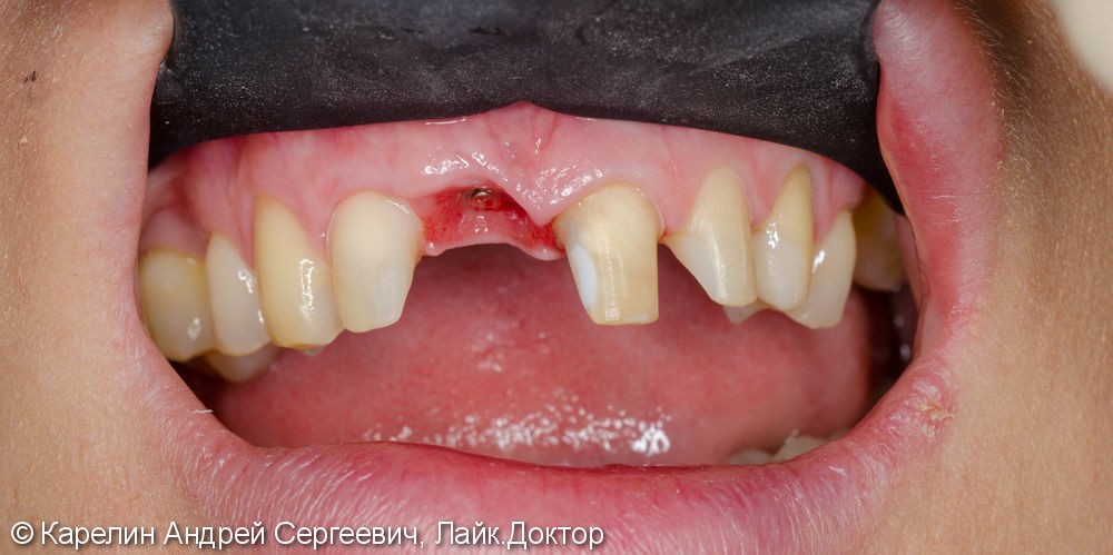 Эстетическая реабилитация фронталной группы зубов с помощью имплантата, коронок и виниров E.max - фото №5
