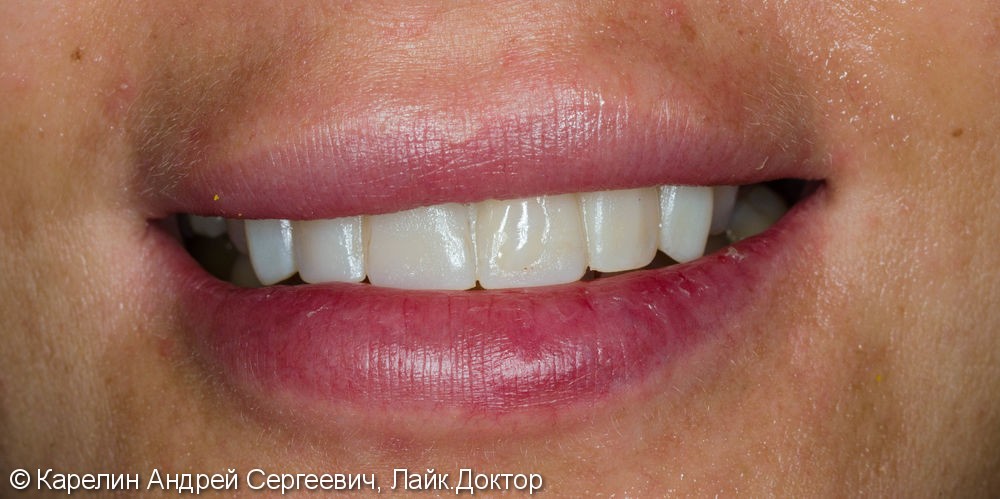 Эстетическая реабилитация фронталной группы зубов с помощью имплантата, коронок и виниров E.max - фото №6