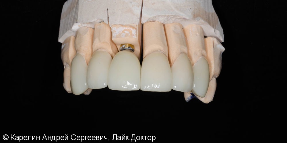 Эстетическая реабилитация фронталной группы зубов с помощью имплантата, коронок и виниров E.max - фото №7