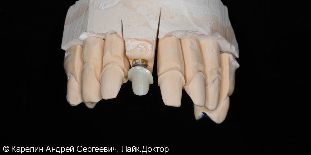 Эстетическая реабилитация фронталной группы зубов с помощью имплантата, коронок и виниров E.max - фото №8