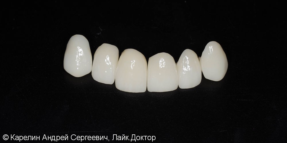 Эстетическая реабилитация фронталной группы зубов с помощью имплантата, коронок и виниров E.max - фото №9