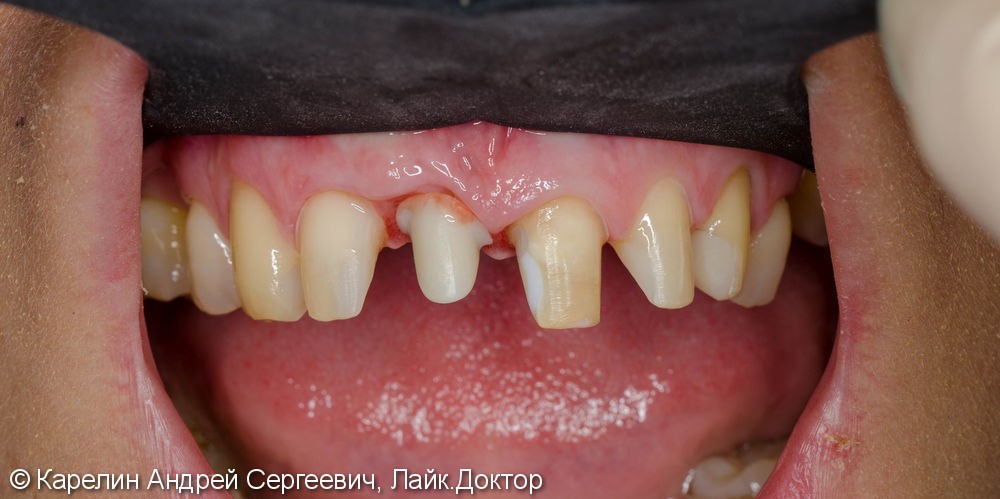 Эстетическая реабилитация фронталной группы зубов с помощью имплантата, коронок и виниров E.max - фото №10