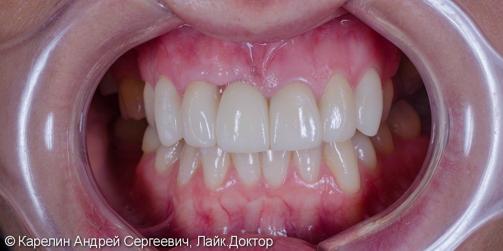Эстетическая реабилитация фронталной группы зубов с помощью имплантата, коронок и виниров E.max - фото №11