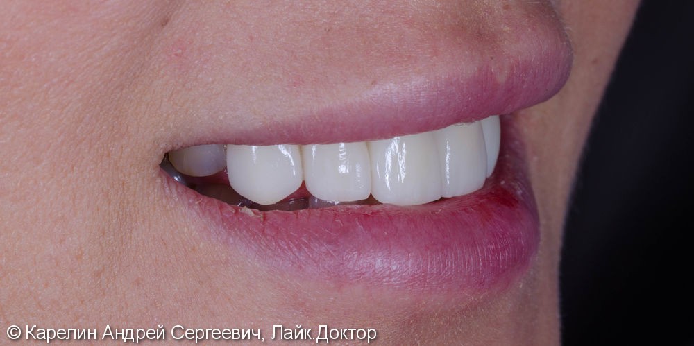 Эстетическая реабилитация фронталной группы зубов с помощью имплантата, коронок и виниров E.max - фото №12