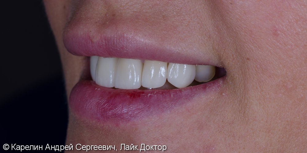 Эстетическая реабилитация фронталной группы зубов с помощью имплантата, коронок и виниров E.max - фото №13