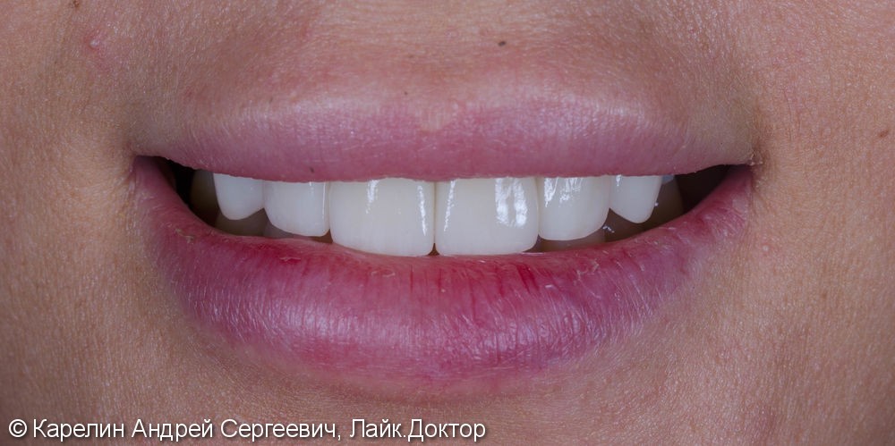 Эстетическая реабилитация фронталной группы зубов с помощью имплантата, коронок и виниров E.max - фото №14