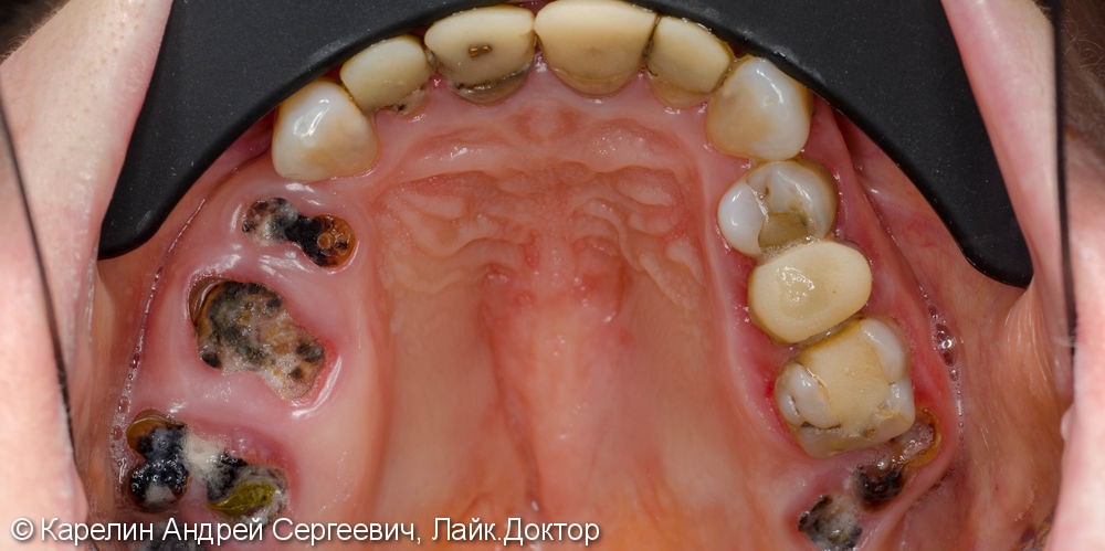 Полная реабилитация обеих челюстей с помощью металлокерамических коронок и съёмного протезирования - фото №5