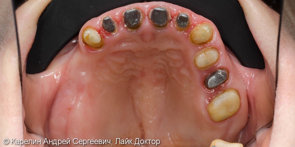 Полная реабилитация обеих челюстей с помощью металлокерамических коронок и съёмного протезирования - фото №7
