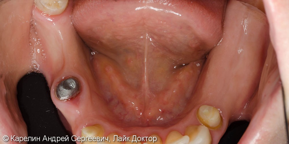 Полная реабилитация обеих челюстей с помощью металлокерамических коронок и съёмного протезирования - фото №8